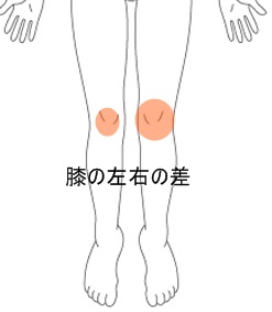 膝 に 水 が 溜まる