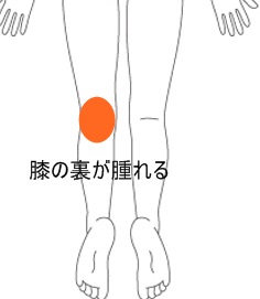 左ひざの裏に水がたまる 西宮で腰痛 手術寸前も可 ならダントツ地域no 1整体院